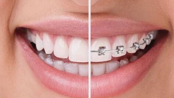 orthodontie-importance-du-traitement