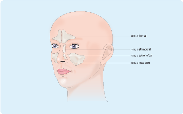 sinusite-chronique-face