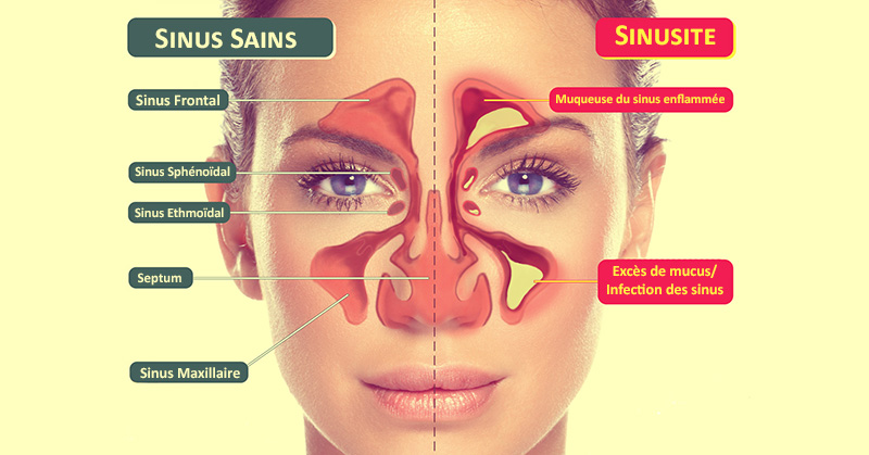 sinusite-chronique-sinus
