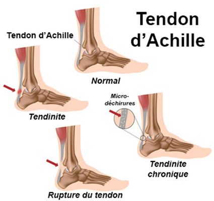 tendinite-tendon-dachille